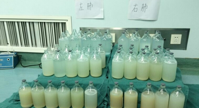 男子患罕见呼吸困难 医生建立人工心肺洗出90瓶垃圾