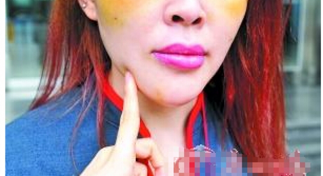 33岁女子整容成瘾:5年花30万整容十几次 痛并快乐着