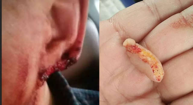 一言不合便动嘴 因狗起争执狗主人咬掉男子耳垂