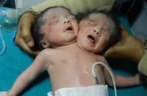孟加拉再现世间罕见双头婴 如何预防畸形婴儿