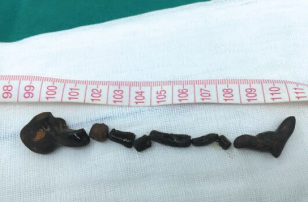 10厘米蛔虫在老妇胆管安家 蛔虫尸体被胆汁包裹成结石