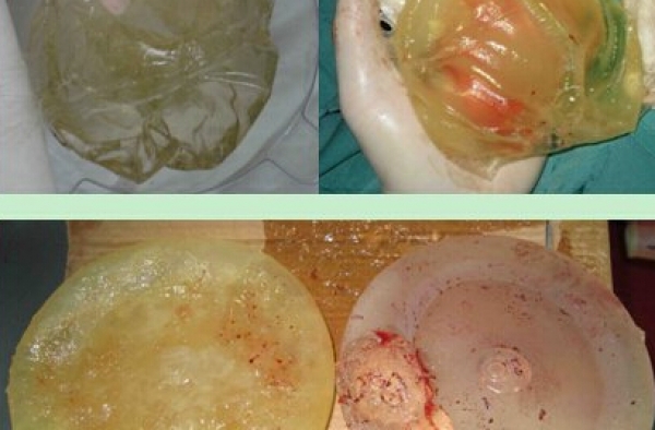 女子8年隆胸假体破裂 “顺胸而下”的硅胶烂穿大腿