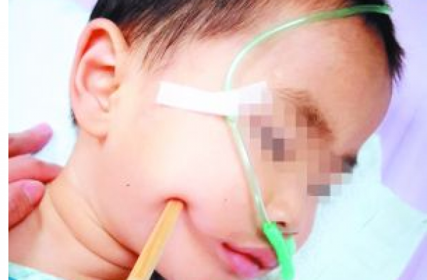 2岁男童拿碗筷玩耍摔倒：筷子插入脑袋 3厘米入颅脑