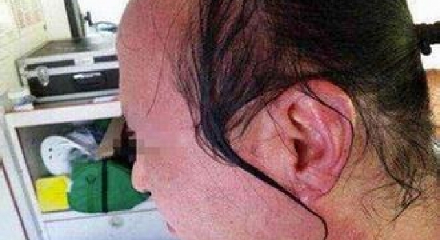 男子熟睡中被泼了一锅开水 竟因为泄露好友私事遭报复