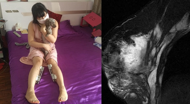 花钱买罪受!整形狂人手术200多次 乳房如石头面临切除