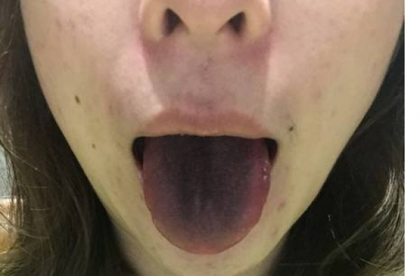 女子吃火锅舌头变黑拉肚子 商家:没及时加汤铁离子分离