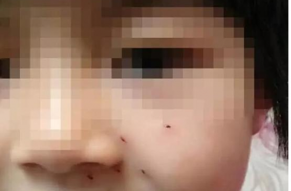 因10+9没算好 6岁女童被老师用铅笔在脸上扎6个洞