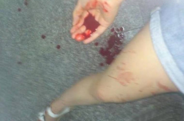 中学生早恋被发现分手 少女求和好被拒绝后捅伤男友