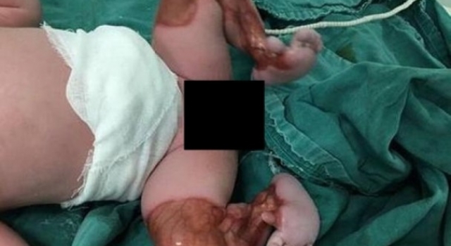 罕见！新生儿双腿透明可见血管和肌肉 病因不明