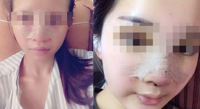 女子鼻贴胶布被劝下飞机 当事人：我真的没整容！