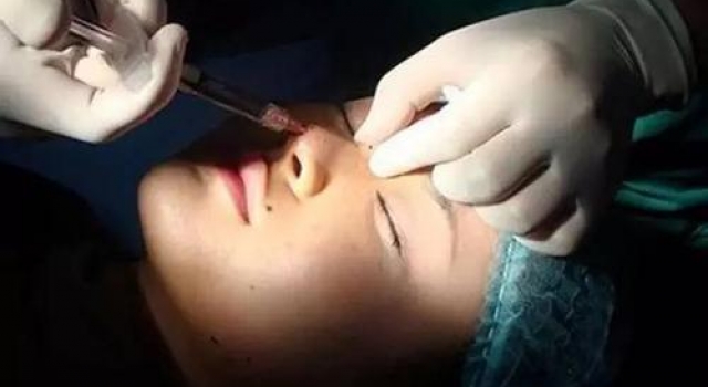 女子注射脂肪致终生失明 为求“天庭饱满”终酿大祸