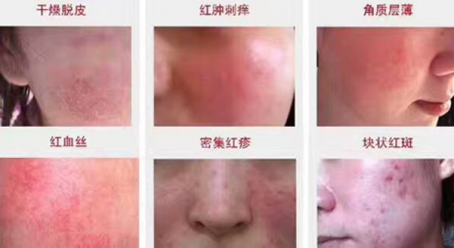 激素脸排毒高峰期反跳症状图？排什么毒？持续多久？怎么才能好