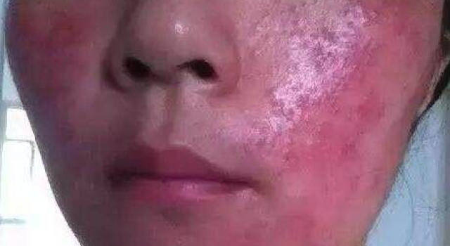 激素脸初期可以自愈吗？激素脸多久能恢复正常