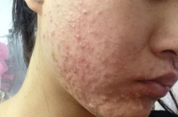 激素脸有炎症怎么治疗 推荐激素脸的治疗土方法