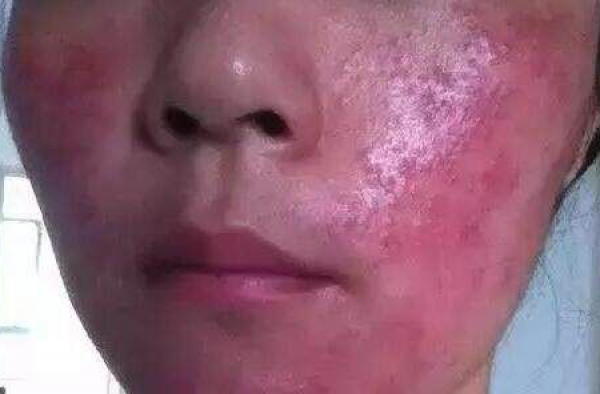 激素脸流黄水结痂怎么办 那么激素脸结痂多久会脱落