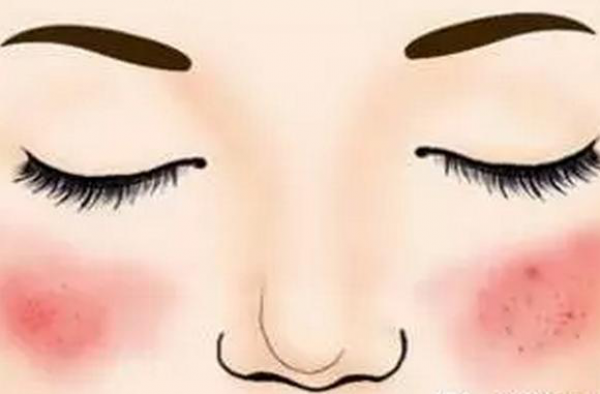 脸过敏了又红又痒怎么办 分析脸反复过敏是激素脸吗