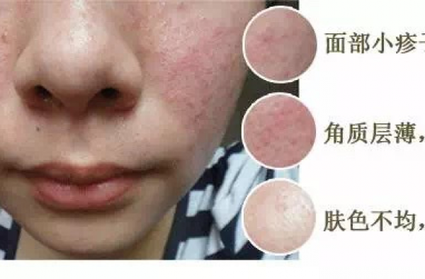 激素脸戒断是什么意思？激素脸戒断反应会出现哪些症状