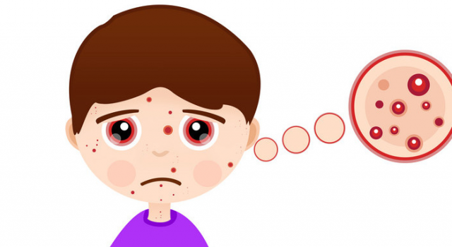 激素脸满脸小疹子怎么办？激素脸排毒过程中很痒专业方法拯救你