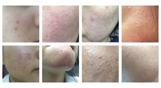 激素脸干用什么方法补水？激素脸干燥紧绷脱皮涂补水修复产品