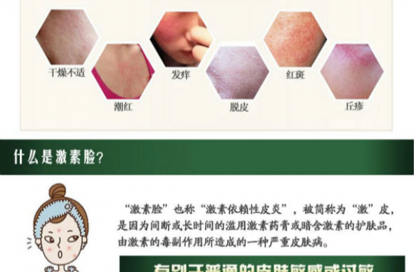 激素脸擦什么药好得快?一旦得了激素脸怎么快速代谢掉