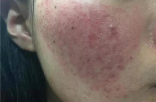 这三个祛痘要点 千万要注意 否则痘痘更严重