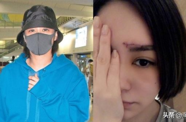 眉骨留疤，钟欣潼（阿娇）已秘密返港，3个月后磨皮？